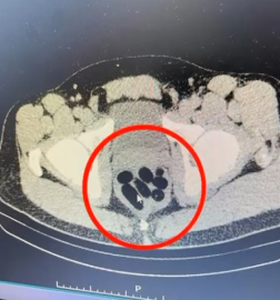 Midesinden yarım kilo metamfetamin çıktı