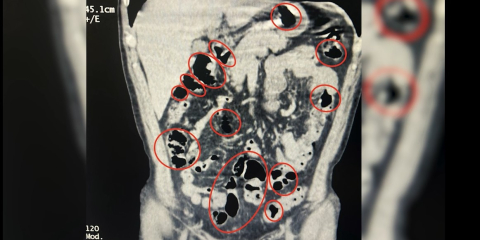 Yabancı uyruklu 2 kişinin mide ve bağırsaklarından uyuşturucu çıktı