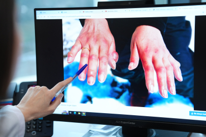 ‘Kış aylarında soğuk ısırığı vakaları artıyor’