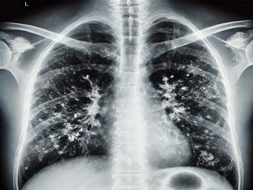 'Kışın solunum yolu enfeksiyonlarında artış doğal, hijyen şart'