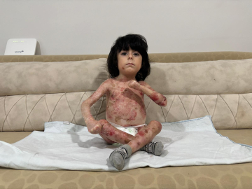 4 yaşındaki İbrahim, 'Kelebek hastalığı' nedeniyle kıyafet giyemiyor